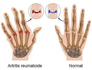 artritis-reumatoide