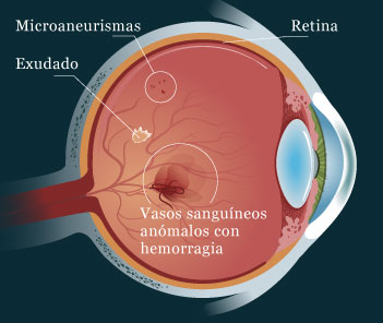 otherconditiondiab-illustration