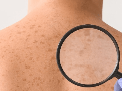En México se registraron 2.198 nuevos casos de melanoma de piel y 833 muertes por esta enfermedad